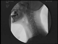 X-ray of throat